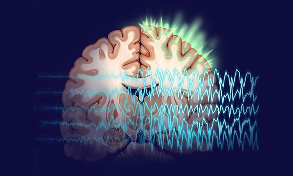Image representing section of brain showing area of focal seizure, overlaid with EEG. New guidelines have been issued on training carers in first-line emergency treatment for epileptic seizures in the community.