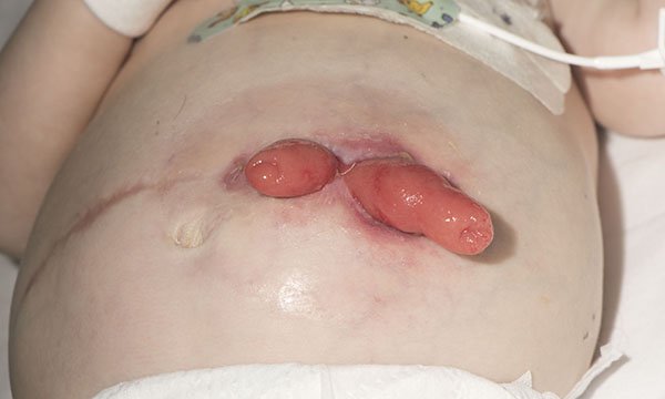 Baby with stoma