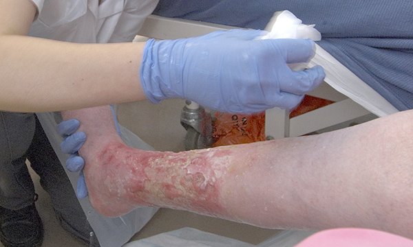 A nurse dresses a heavily ulcerated lower leg