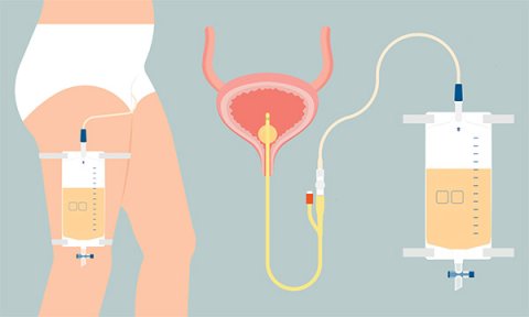 Use of indwelling catheters and preventing catheter-associated urinary tract infections