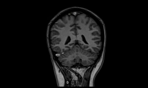 Cerebral venous thrombosis in the puerperium: a reflective case study
