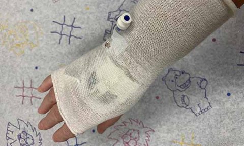 Reducing pressure injuries in children caused by peripheral intravenous cannulae