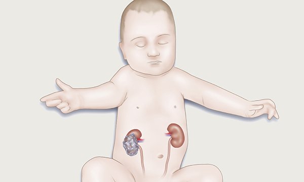 Diagram of Wilm’s tumour in a baby