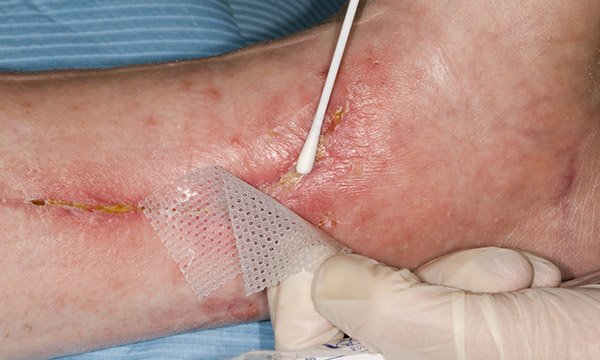 An overview of the prevention and management of wound infection