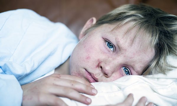 A tired and ill child with measles lies down in bed