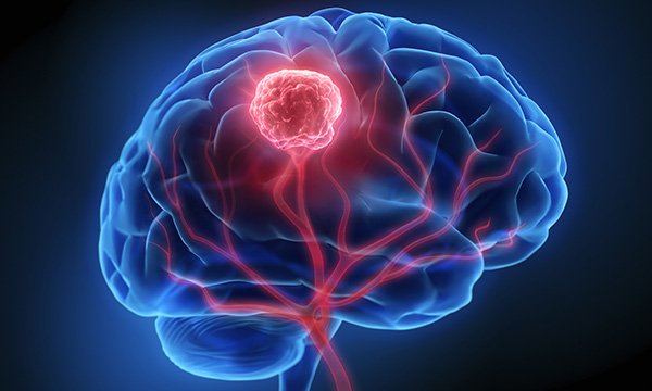 Adult primary brain tumours: presentation, diagnosis, treatment and complications