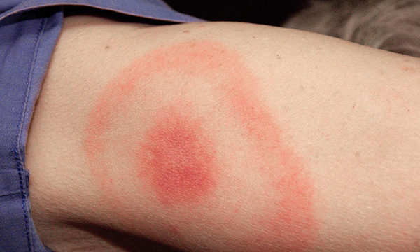 Lyme disease: recognition and management for emergency nurses