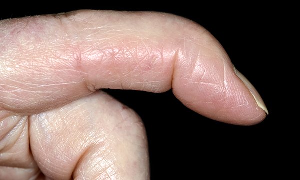 Mallet finger injuries: the signs, symptoms, diagnosis and management